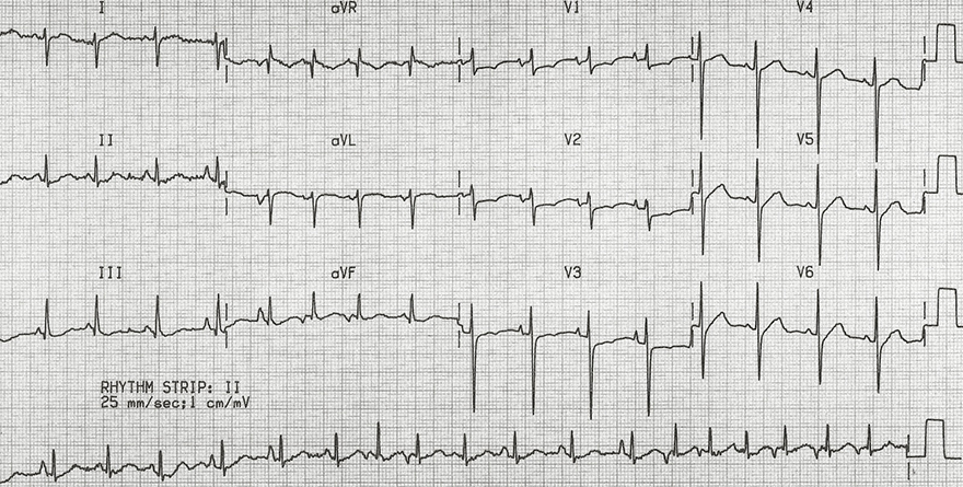 ECG multifocal atrial tachycardia, irregular rhythm