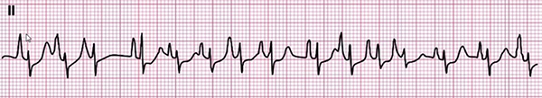 ECG multifocal atrial tachycardia