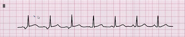 ECG wandering pacemaker rhythm