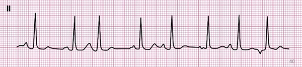 ECG wandering pacemaker