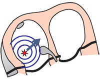 Ectopic pacemaker right atrial focus