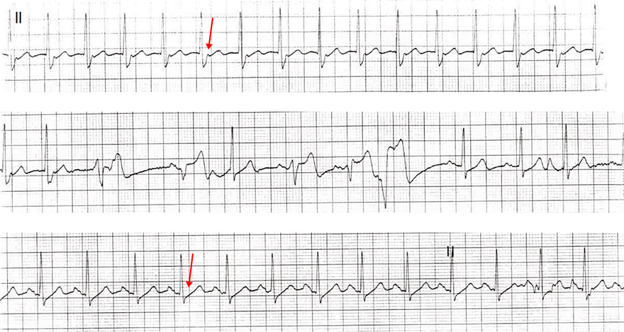 ECG short RP tachycardia, typical slow-fast AVNRT - pseudo r wave, adenosin, sinus rhythm