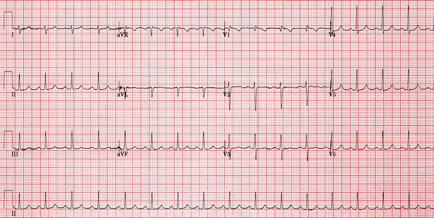 ECG sinus rhythm