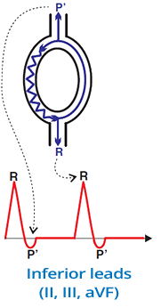 slow-fast avnrt mechanism