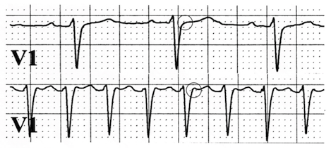 ECG typical slow-fast avnrt (V1 lead), pseudo r wave, and sinus rhythm