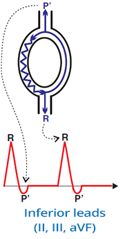 ECG, pseudo S wave, Typical AVNRT, slow-fast AVNRT