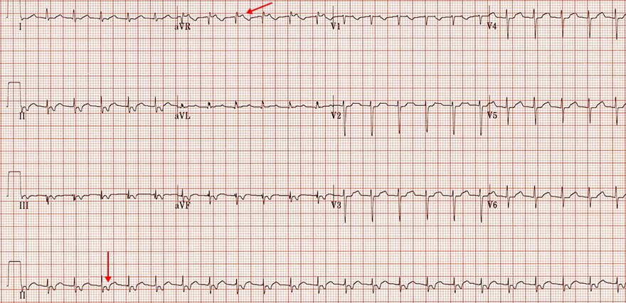 ECG short RP tachycardia, slow-slow AVNRT, RP, PR interval