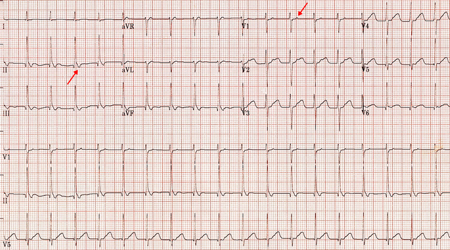 ECG short RP tachycardia, slow-slow AVNRT