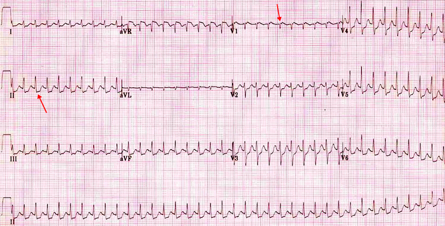 ECG common slow-fast AVNRT