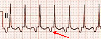 ECG (II) atypical AVNRT, Long RP tachycardia