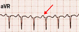 ECG (aVR) atypical AVNRT, Long RP tachycardia