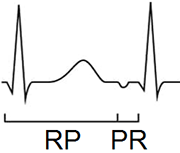 fast slow avnrt, rp pr interval