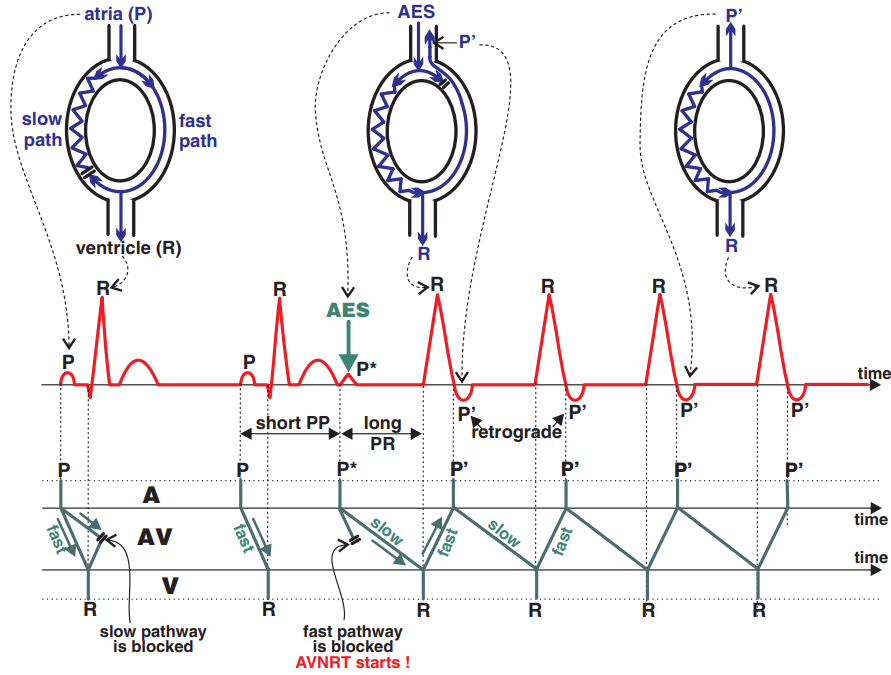 ECG, laddergram, mechanism AVNRT, sinus rhythm, early atrial extrasystole, short PP, long PR, slow and fast pathway