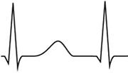 slow fast avnrt rp pr interval, no P waves