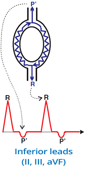 slow-slow AVNRT mechanism