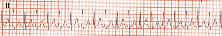 ECG Orthodrome AV Re-entry Tachcardia, Narrow QRS complex preceded by a p-wave