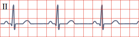 ECG sinus rhythm vs. junctional rhythm