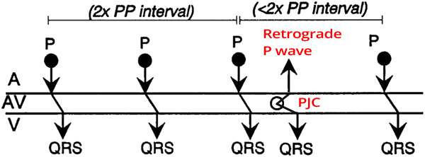 ECG Laddergram, Junctional Premature Complex, Non-compensatory Pause