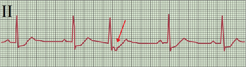 ECG prejature juncional complex, retrograde p wave after narrow qrs complex