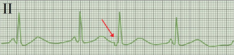 ECG premature junctional complex, retrograde p wave, short PR interval, Non-compensatory pause