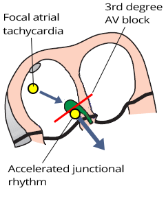 atrial focal tachycardia, accelerated junctional rhythm, av dissociation, 3rd degree complete av block