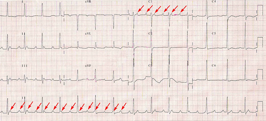 ECG atrial focal tachycardia, accelerated junctional rhythm, av dissociation, 3rd degree complete av block