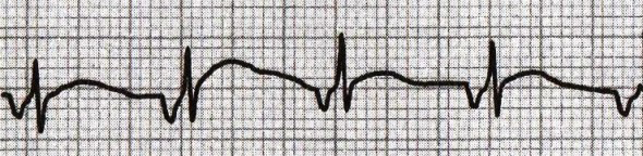 ecg upper accelerated av junctional rhythm, 98 bpm