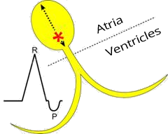 lower Atrioventricular junctional rhythm