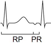 RP interval, Pseudo (Slow-Slow) AVNRT, Coumel's tachycardia