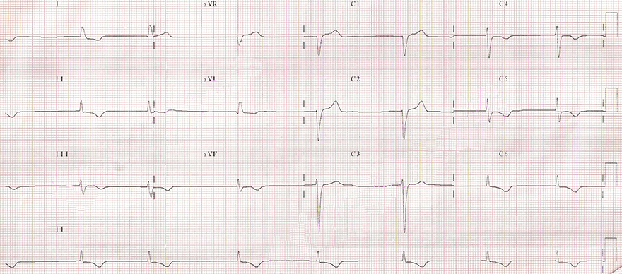 ECG junctional AV middle rhythm, 45 bpm