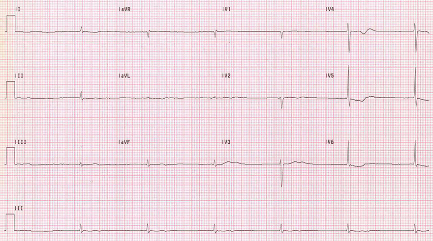 ECG junctional middle av bradycardia, 37bmp