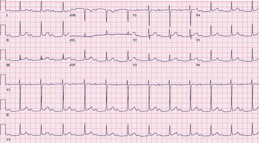 ECG first degree heart block, prolonged PQ interval