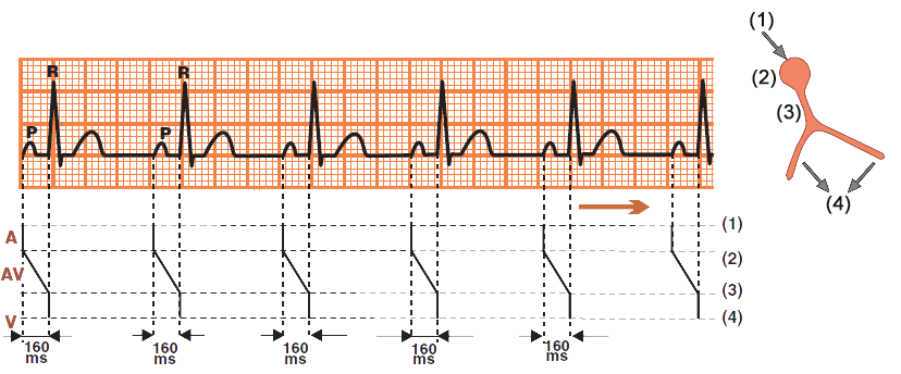 ECG and Laddergram conduction via av node, normal sinus rhythm