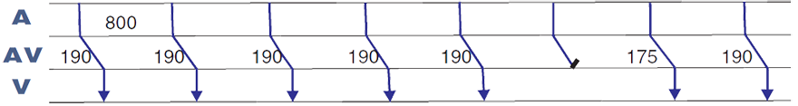 ECG second degree AV block Wenckebach