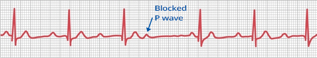 ECG 2nd degree AV block, Mobitz I, Wenckebach, P:QRS ratio 4:3