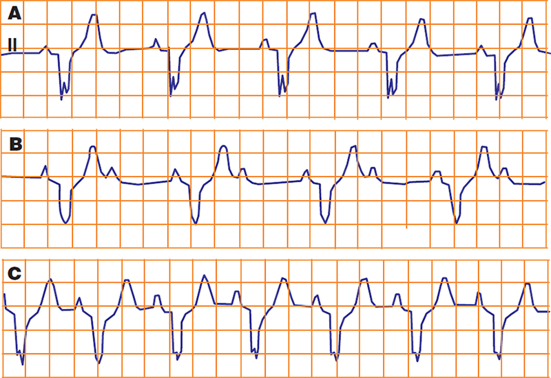 ECG development of 2:1 AV block induced by exercise