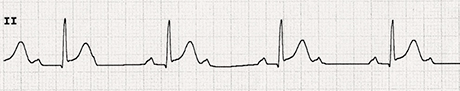 ecg second heart degree block, fixed ratio 2:1, mobitz 1 vs. mobitz 2