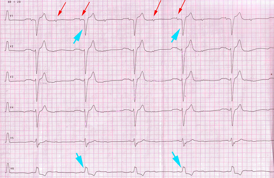 ECG AV block, ratio 2:1, mobitz I vs. mobitz II