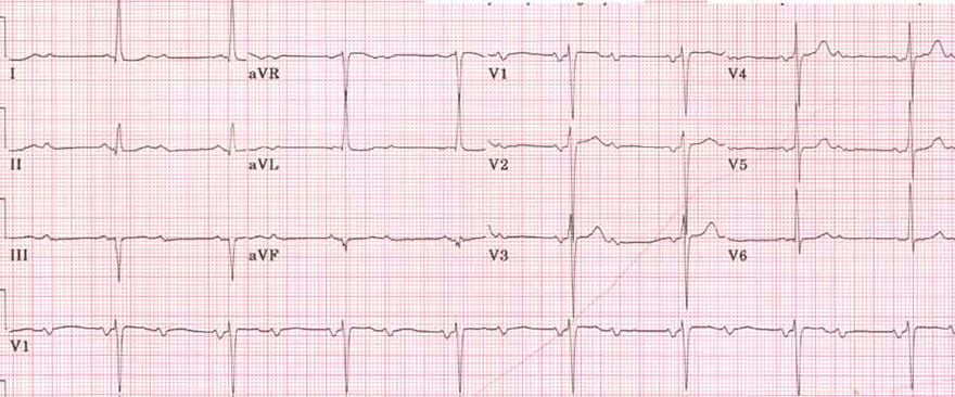 ECG second degree av block, ratio 2:1, narrow qrs