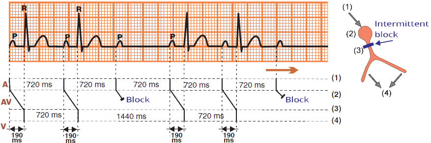 ECG and Laddergram, 2nd degree AV block, Mobitz 2, narrow QRS complex, constant PR interval