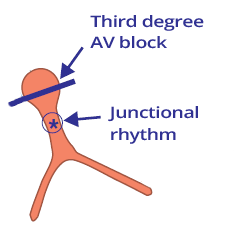 3rd AV block, junctional escape rhythm