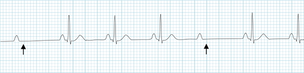 ECG 2nd degree AV block, Mobitz 2, narrow QRS