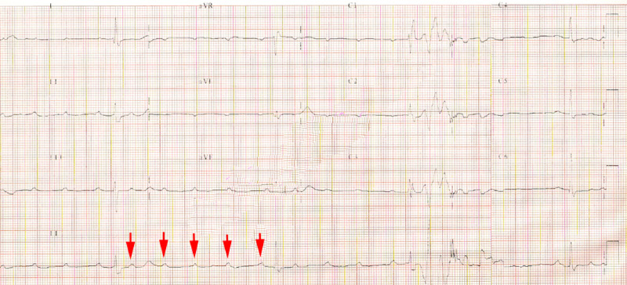 ecg ecg infra hisian block, 2nd degree av block, mobitz II