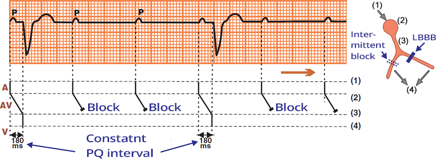 ECG, laddergram, 2nd degree, high-grade AV block