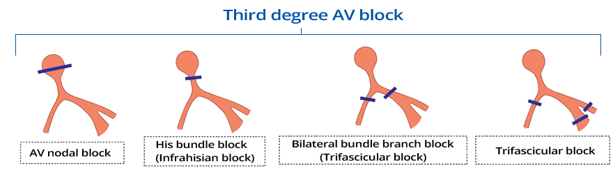 3rd complete av block, AV nodal block, His bundle block, Bilateral bundle branch block, Trifascicular block