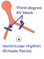 3rd AV block, ventricular escape rhythm