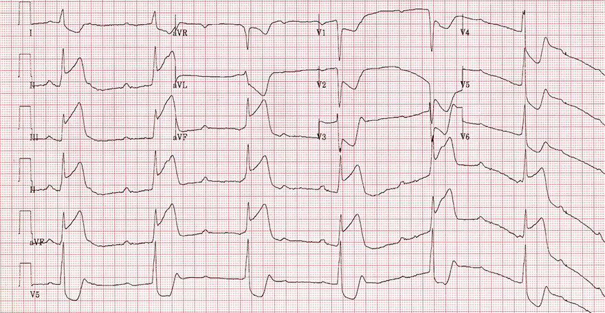 ECG complete av block, inferior STEMI infarction