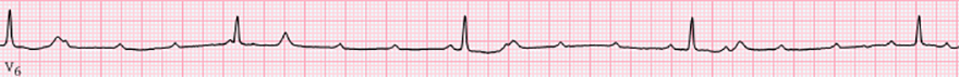 ECG complete av block, av dissociation, junctional escape rhythm