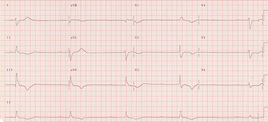 ECG AV dissociation, complete AV block