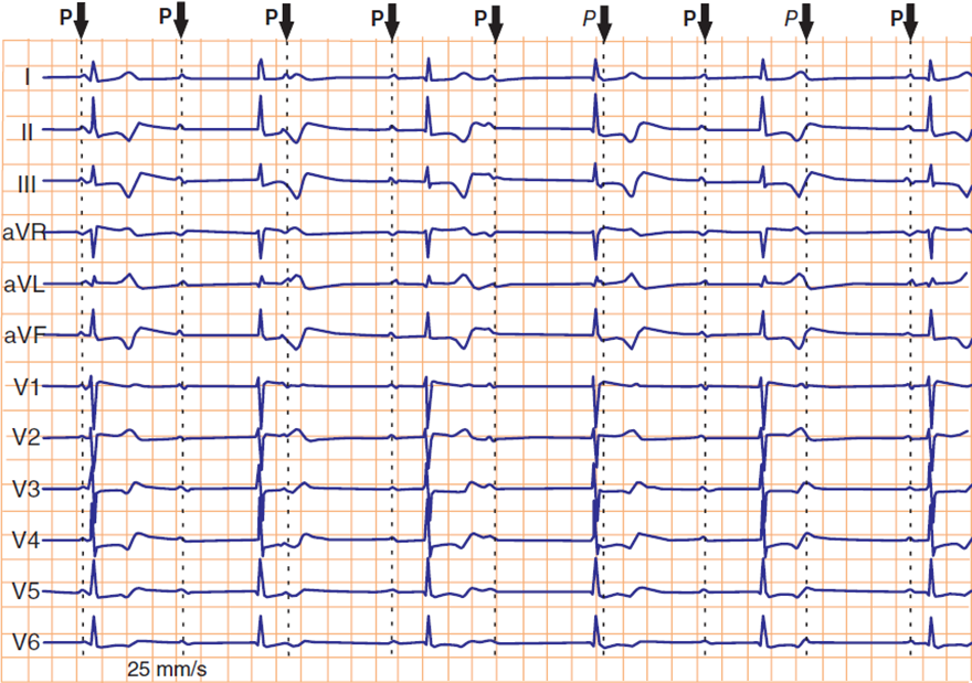 ecg complete 3rd degree atrioventricular (AV) block